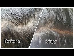 Remove Dandruff In Just 1 Wash Using Super Effective Home Remedy Click Here For The No 1 Itchy Scalp Dandruf Dandruff Thick Hair Remedies Dry Scalp Remedy