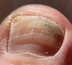 Image result for onychomycosis