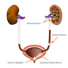 Kidney Stone Overview Symptoms Diagnosis Treatment Options
