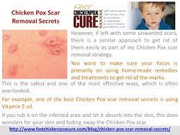 If a vaccinated person does get chickenpox, the symptoms are usually milder with fewer or no blisters (they may have just red spots) and mild or no fever. Chicken Pox Scar Removal Secrets