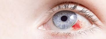 Glokom Goz Tansiyonu Nedir Prof Dr Vedat Kaya