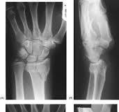 Open reduction and internal fixation of distal radial ...