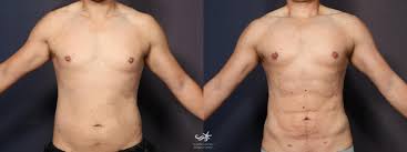 Image result for Liposuction