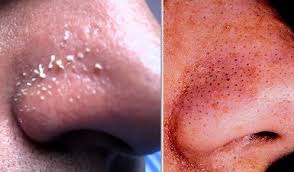 Daun yang berasal dari tanaman gambir ini bisa digunakan untuk cara menghilangkan flek hitam di kaki. 9 Cara Semulajadi Hilangkan Blackhead Whitehead Pada Wajah