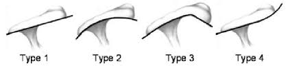 Facebook gives people the power to share and makes. The Different Acromial Shapes Flat Curved Hooked And Reversed Download Scientific Diagram