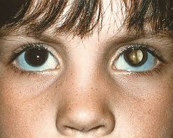 Sometimes cancer can spread to the eye from another part of the body. Childhood Eye Diseases And Conditions American Academy Of Ophthalmology