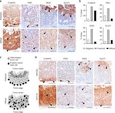 A yellow ribbon represents sarcoma or bone cancer. Multicolor Lineage Tracing Reveals Clonal Architecture And Dynamics In Colon Cancer Nature Communications