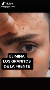 Elimina Los Granitos De La Frente Video Como Quitar Granos Trucos Naturales De Belleza Tips De Belleza Caseros