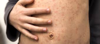 Image result for vyrážka u dětí