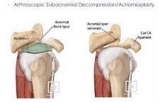 Image result for icd 10 code for left shoulder subacromial decompression