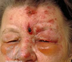 Image result for shingles
