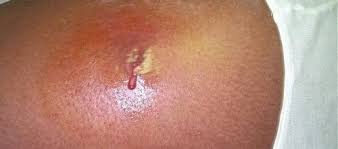 Image result for Skin Abscess