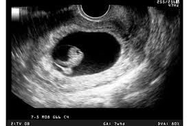 This is called the dating scan. Wrong Due Date From Ultrasound Scan Why It Happens Madeformums