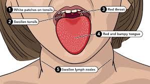 Image result for Strep throat infection roof of mouth