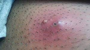 I think it started as an ingrown hair and i messed with it and messed with it and now there is the lump. Ingrown Hair Cyst Treatments Causes And Prevention