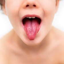 Image result for Scarlet Fever