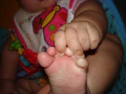 What Is Restless Legs Syndrome Rls Baby Sleep Advice For Parents Kids