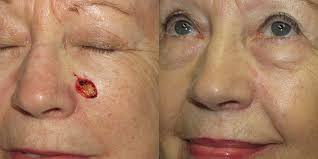 Caring for your wound after your skin procedure is important to help prevent infection and help you heal with little pain or discomfort. Linear Closure Skin Cancer And Reconstructive Surgery Center