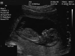 The dating scan usually takes about 20 minutes. Evaluation Of Gestation Overview Clinical Methods Of Estimating Gestational Age Estimating The Delivery Date