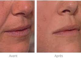 Plasma pen contre les rides, cernes, vergetures. Avant Apres Hyaluron Pen Ang Elle Lui A Gland