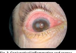 Image result for Gonococcal Conjunctivitis