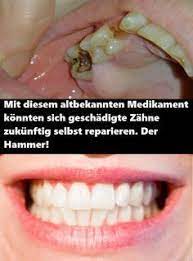 Wenn Ein Zahn Ein Kariesbedingtes Loch Hat Oder Z B Beim Kauen Ein Stuck Von Ihm Abgebrochen Ist Kommen Zahnfullungen Zum Einsa Zahne Karies Karies Entfernen