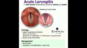 Image result for Acute Laryngitis
