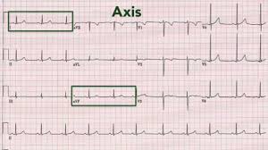 ecg interpretation recognising normal