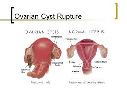For the most part, these functional cysts are small and go away without you ever knowing about them. Female Reproduction Alterations Female Reproductive Organs Fetal Chromosome