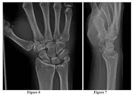 Image result for Pisiform Bone