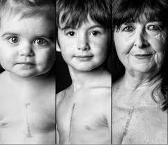 Exposition Photo Notre Cicatrice Association Petit Coeur De Beurre Facebook