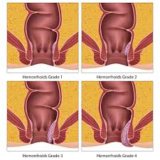 Image result for Hemorrhoid