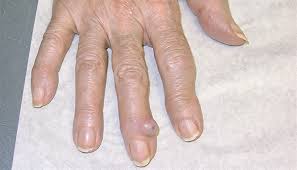 Clinical Challenge: Semi-Translucent Tumor on the Finger - MPR