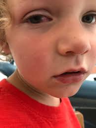 Fundraiser by Cara Cordoni : Help us save Baxter's eye