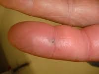 Cleaning your ppe for use around dangerous plants. Flexor Tenosynovitis Melbourne Hand Surgery