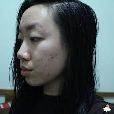 Thoa dầu dừa lên da trong 1 tuần để chữa sẹo mụn, cô nàng này đã nhận được  kết quả đáng thất vọng