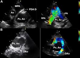 The goal of treatment is to close the pda to prevent your child's doctor may refer to the procedure as transcatheter device closure. the procedure sometimes is done on small pdas to prevent the. Giant Ductal Pseudoaneurysm In Infancy A Lesson Learnt The Hard Way Bmj Case Reports