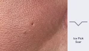 Maybe you would like to learn more about one of these? What Can Be Done For Ice Pick Scars