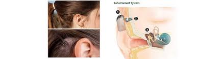 Sait gündoğdu 0 532 609 20 27 avrupa: Bone Anchored Hearing Aid Baha Michigan Ent Allergy Audiology