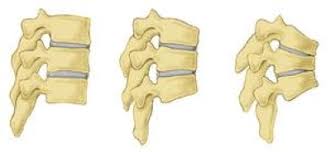Osteoporosis is a disease where decreased bone strength and mass significantly increase the risk of fractures. Osteoporosis Orthoinfo Aaos