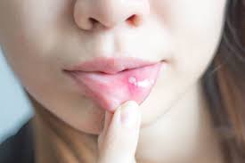 Wenn sie ein taubes gefühl in der wange verspüren, kann dies ein anzeichen für eine entzündung oder eine schädigung eines gesichtsnervs sein. Aphten Orale Aphtose Ursachen Therapie Und Vorbeugung