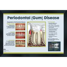 Dental Wall Art Periodontal Disease Chart 16x20 Daw014s Daw014