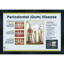 dental wall art periodontal disease chart 16x20 daw014s daw014