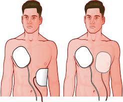 Image result for Transcutaneous Pacing