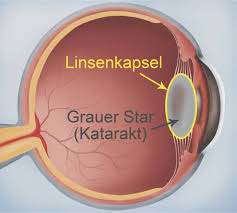 Wann ein grauer star operiert wird, hängt von verschiedenen faktoren ab. Grauer Star Operation Im Augencentrum Rosenheim