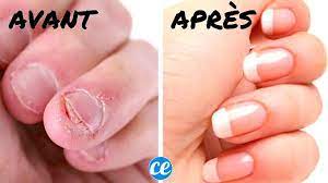 6 Astuces Qui Marchent Pour Ne Plus Jamais Vous Ronger Les Ongles