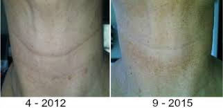 We did not find results for: Does Vitamin C Serum Help Treat Turkey Neck