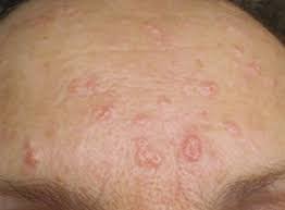 Image result for Sebaceous Hyperplasia