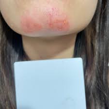 求救下巴突然大爆腫😢 - 美妝板 | Dcard