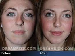 Crooked Nose Before And After Crooked Nose Rhinoplasty Rhinoplasty Before And After